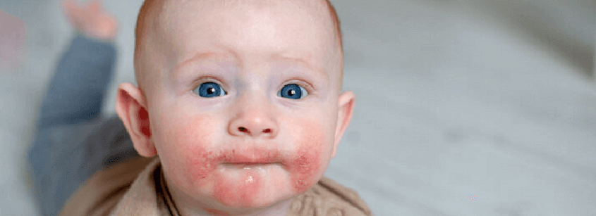 Çocuklarda Oral Alerji Sendromu Nedir