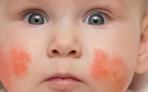 Egzama Tedavi Edilmezse Ne Olur