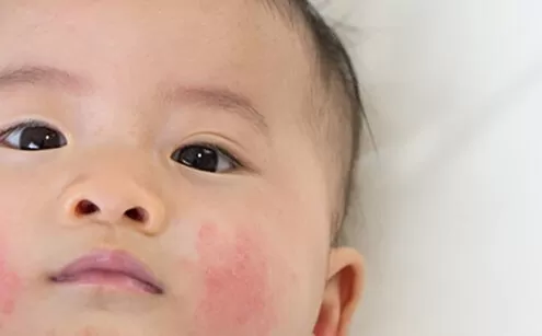 Çocuklarda Egzama Belirtisi Varsa Neler Yapılmalıdır