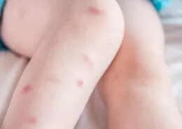 Çocuklarda Sivrisinek Alerjisi